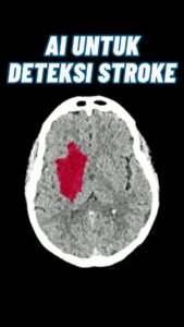 Pemanfaatan AI untuk Pindai Otak Pengidap Stroke